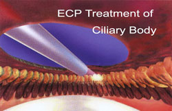 ECP Treatment